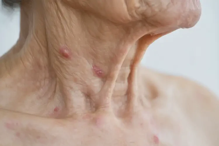老年人脖子上長濕疹不管它會自己好嗎(圖4)