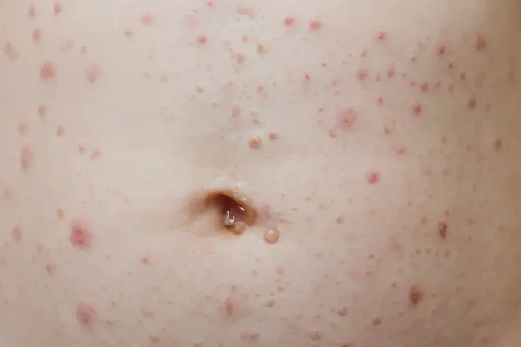 幼兒肚子上經(jīng)常長(zhǎng)濕疹能不能徹底自愈(圖3)