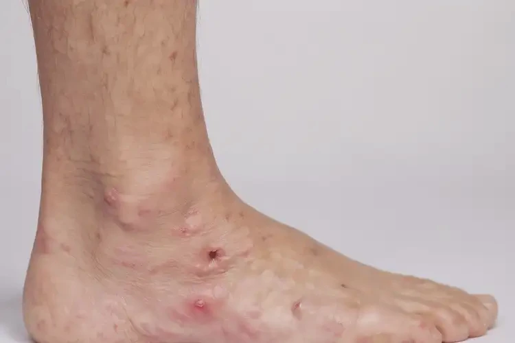 兒童腳上起濕疹能靠自己自愈嗎(圖2)