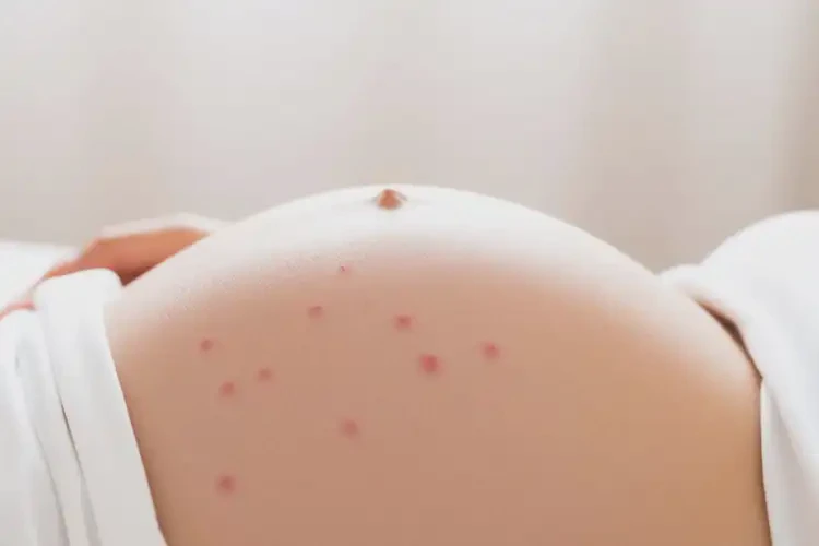 產(chǎn)婦肚子上偶爾長濕疹能徹底自愈嗎(圖4)