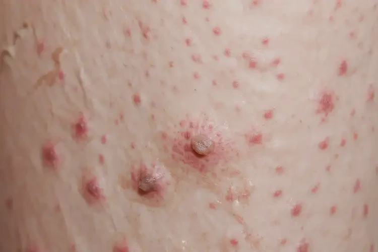 女人小腿有濕疹能夠徹底治愈嗎(圖4)