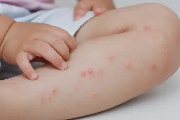 小兒大腿偶爾起濕疹可不可以徹底自愈(圖4)