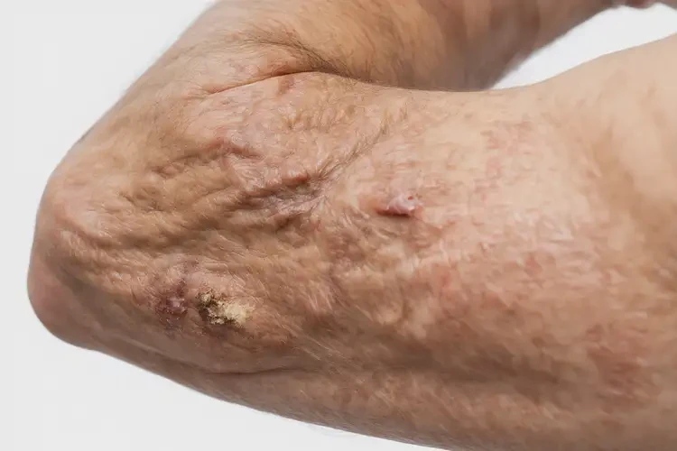 青年人身上起濕疹不管它會(huì)自己痊愈嗎(圖3)