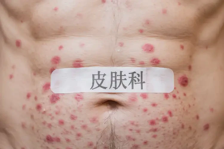 老年人肚子上出现湿疹能彻底自愈吗(图4)