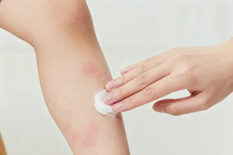 小兒小腿長濕疹不管它會自己自愈嗎(圖1)