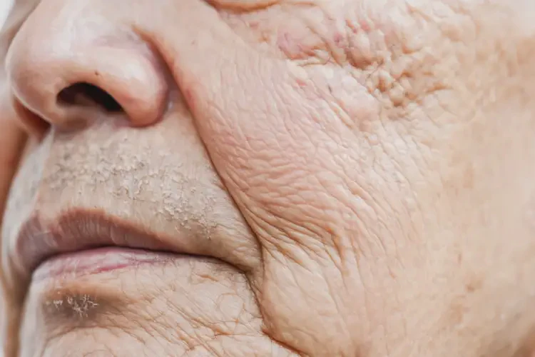 老年人脖子上容易长湿疹能不能彻底自愈(图4)