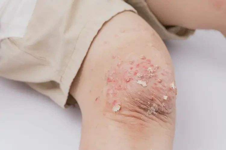 小兒大腿偶爾起濕疹可不可以徹底自愈(圖3)