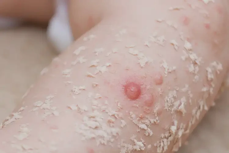 幼儿小腿上容易长湿疹不管它会自己好吗(图4)