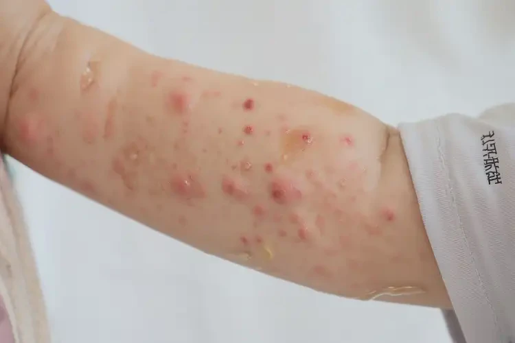 幼兒手臂偶爾長(zhǎng)濕疹能靠自己自愈嗎(圖3)