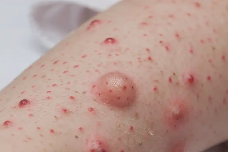 小孩身上起濕疹能靠自己自愈嗎(圖4)