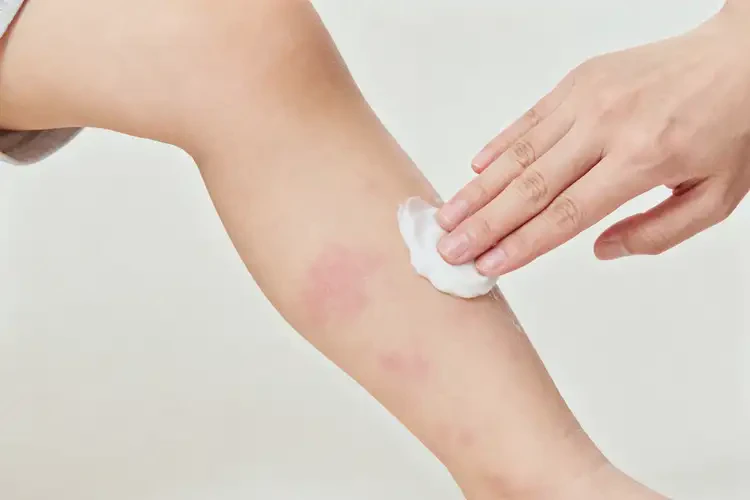 小兒小腿長濕疹不管它會自己自愈嗎(圖2)