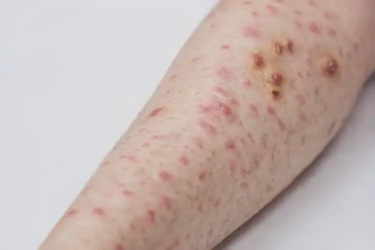 兒童屁股上出濕疹可以徹底自愈嗎(圖3)