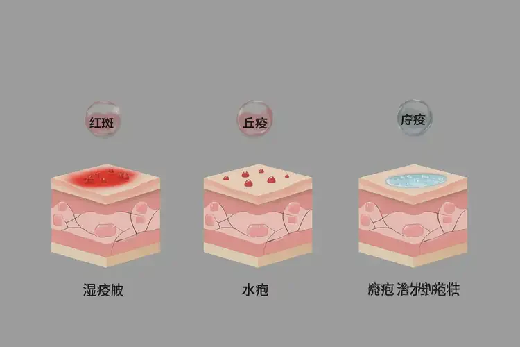 青少年四肢經常長濕疹能徹底自愈嗎(圖3)