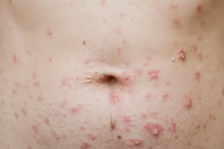 哺乳期媽媽肚子經(jīng)常長(zhǎng)濕疹能夠徹底治愈嗎(圖4)