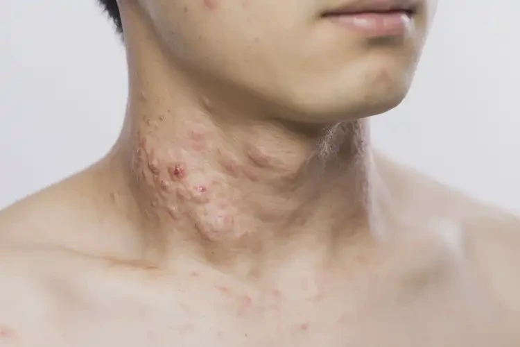 男生脖子上出現(xiàn)濕疹不管它會(huì)自己好嗎(圖4)