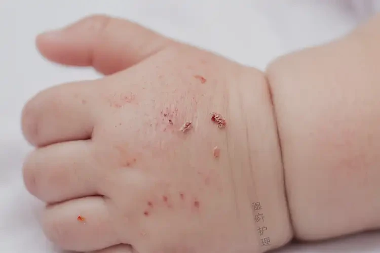 婴儿手上有湿疹能彻底自愈吗(图3)