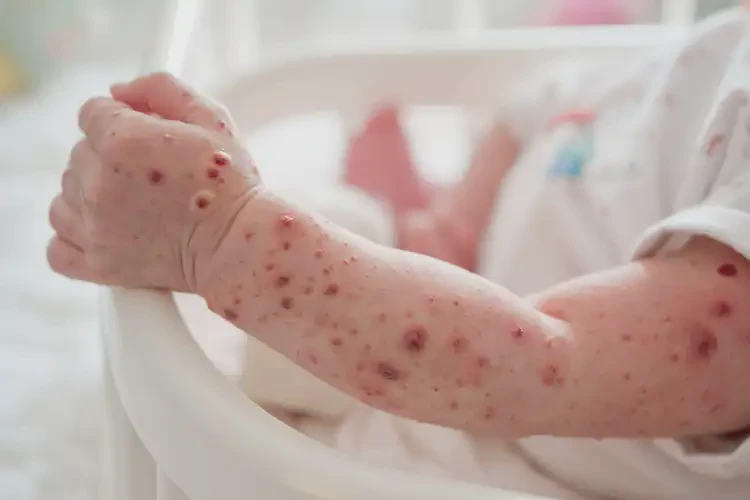 新生儿手臂上偶尔起湿疹可以彻底自愈吗(图4)