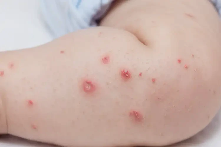 嬰兒小腿經常起濕疹不管它會自己自愈嗎(圖3)