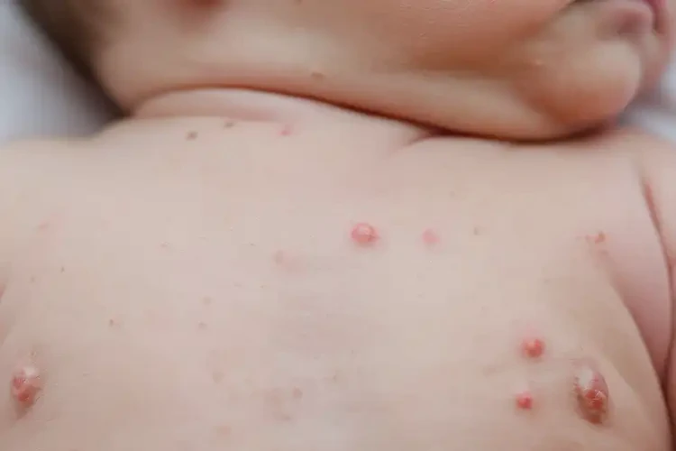 新生兒脖子上出現(xiàn)濕疹可以徹底自愈嗎(圖4)