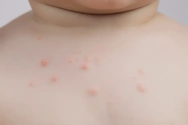 幼兒脖子偶爾長濕疹不管它會自己自愈嗎(圖3)