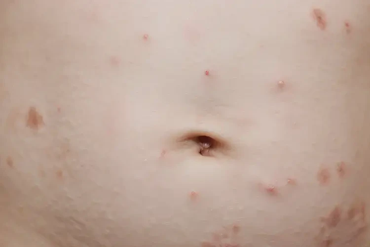 嬰幼兒肚子起濕疹可不可以徹底自愈(圖3)