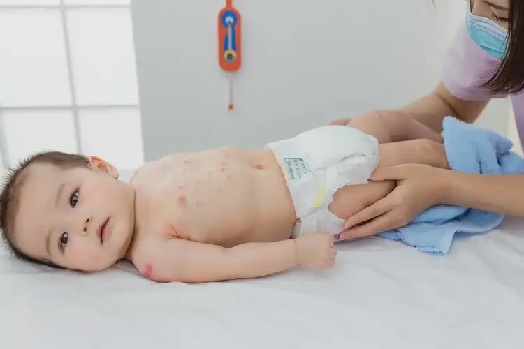 嬰幼兒屁股上長濕疹不管它會自己痊愈嗎(圖3)