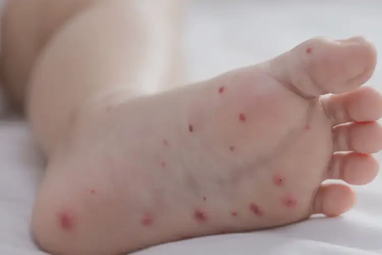 少儿脚上出湿疹可不可以彻底自愈(图4)