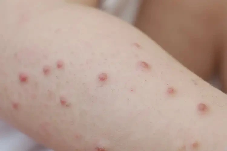 幼兒手臂偶爾長(zhǎng)濕疹能靠自己自愈嗎(圖4)