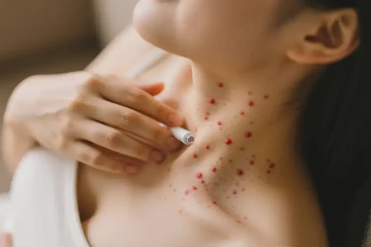 產(chǎn)婦脖子容易起濕疹不管它會自己自愈嗎(圖2)