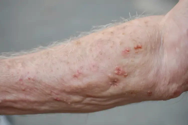 高齡老人手臂上偶爾長濕疹不管它會(huì)自己好嗎(圖4)