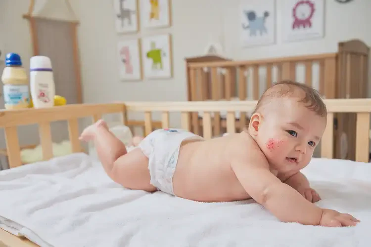 小孩屁股偶尔起湿疹不管它会自己痊愈吗(图2)