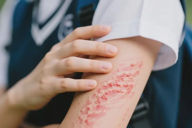 中學(xué)生手臂上起濕疹不管它會(huì)自己痊愈嗎(圖3)