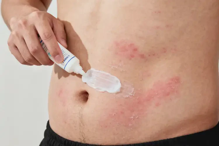 男人肚子經(jīng)常長濕疹可不可以徹底自愈(圖2)