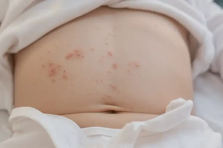 孩子肚子上容易起濕疹可不可以徹底自愈(圖4)