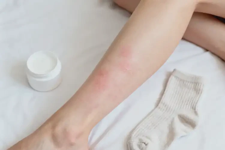 大學(xué)生小腿上偶爾起濕疹可不可以徹底自愈(圖2)