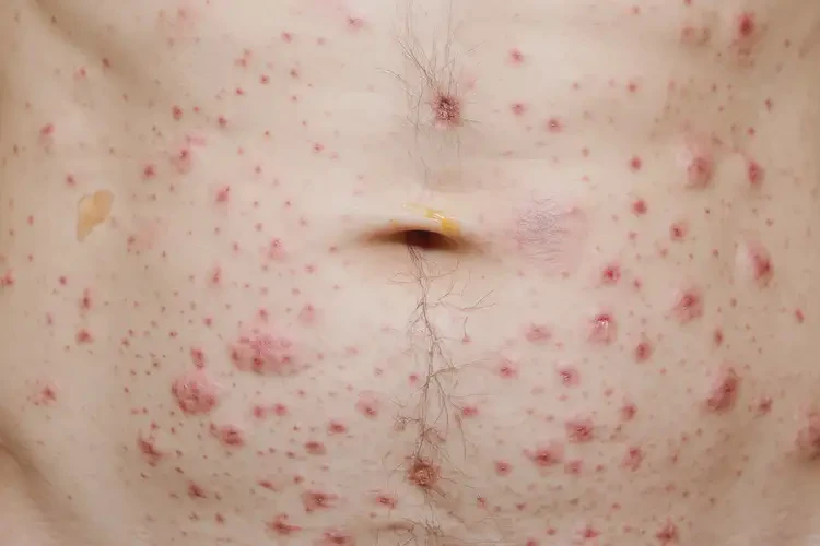 女人肚子上出湿疹不管它会自己好吗(图3)