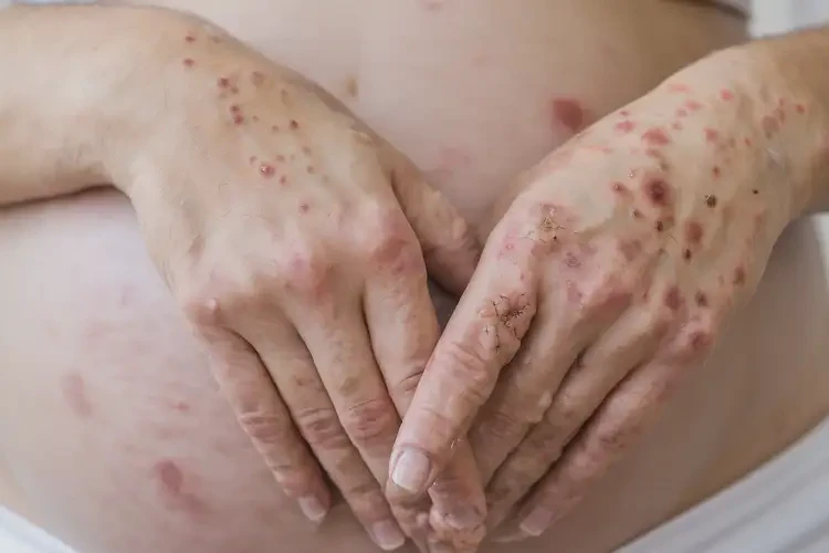 產(chǎn)婦手上起濕疹可以徹底自愈嗎(圖4)