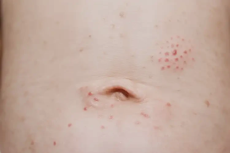 小孩肛周長濕疹可不可以徹底自愈(圖4)