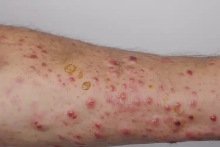 女生手臂上偶爾起濕疹不管它會(huì)自己痊愈嗎(圖4)