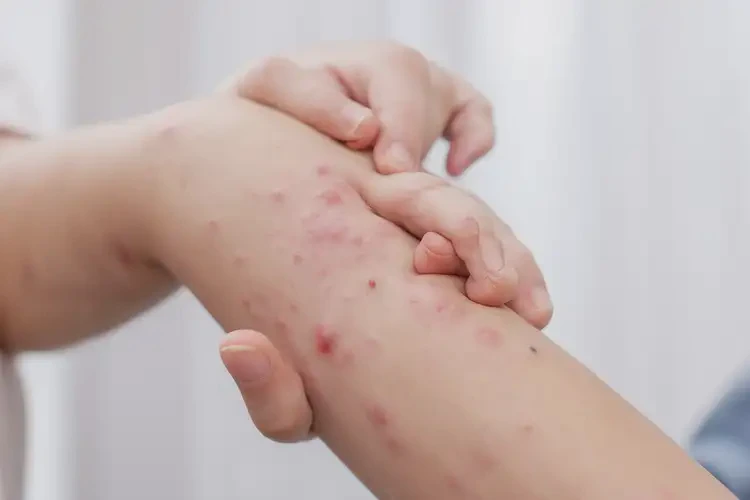 孩子手臂经常长湿疹不管它会自己好吗(图2)