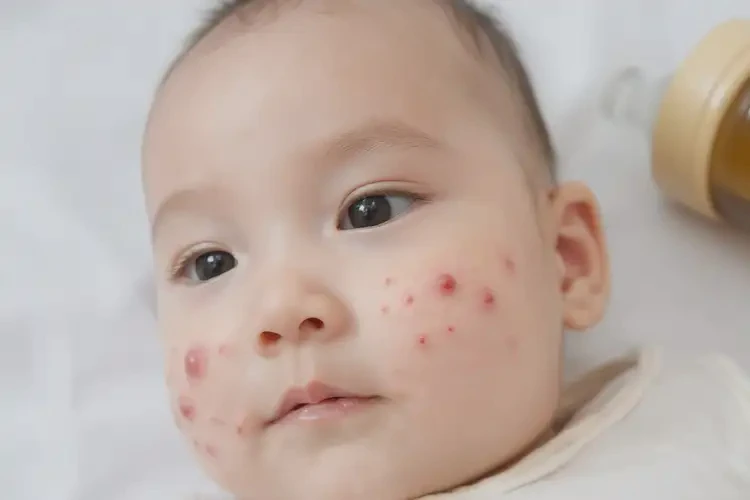 寶寶屁股上起濕疹不管它會自己痊愈嗎(圖4)