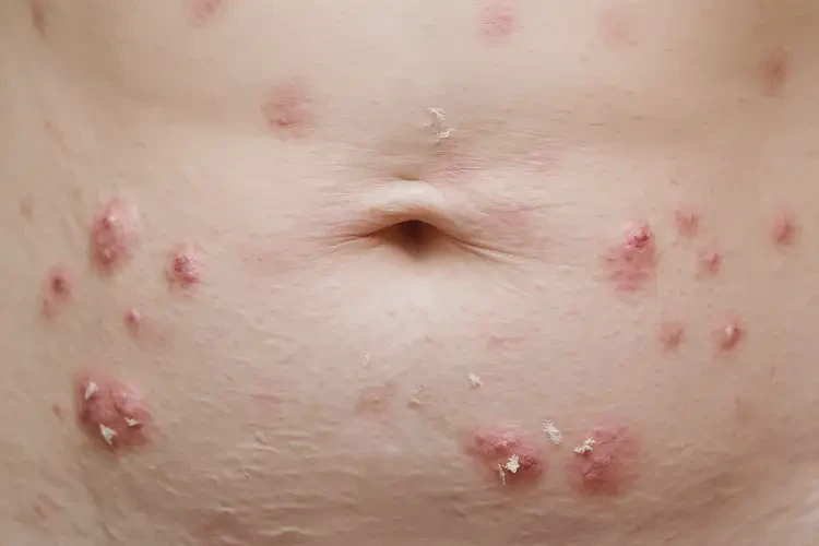 女人肚子出现湿疹可以彻底自愈吗(图4)