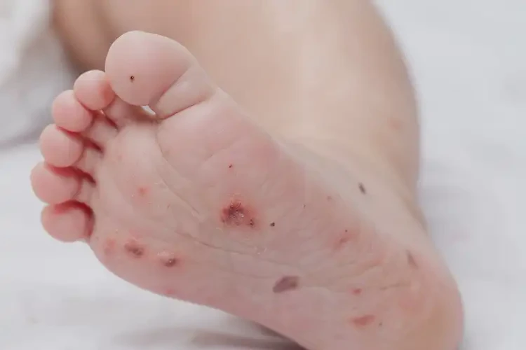 寶寶腳上長濕疹不管它會自己痊愈嗎(圖4)