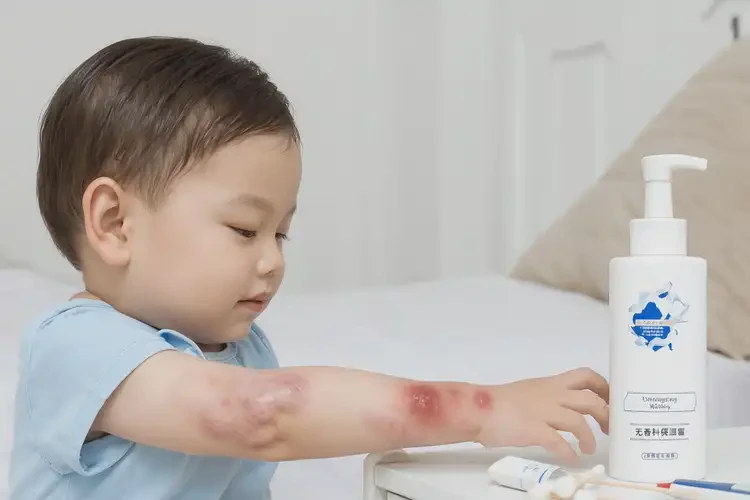 幼兒四肢長濕疹能靠自己自愈嗎(圖4)