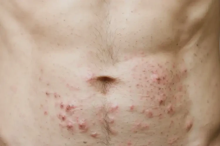 青年人肚子上經(jīng)常長濕疹可以徹底自愈嗎(圖4)