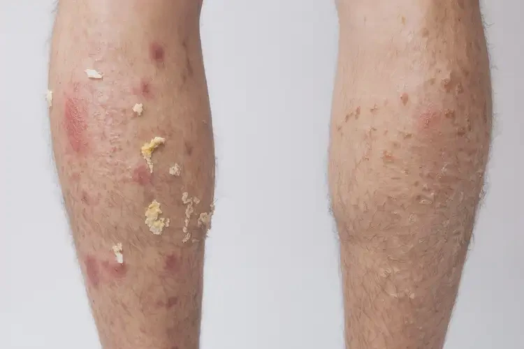 男性小腿有濕疹不管它會(huì)自己好嗎(圖2)