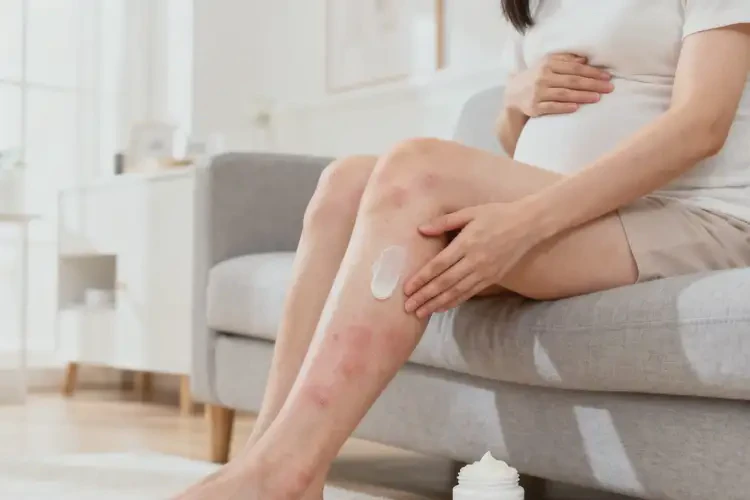 哺乳期媽媽小腿有濕疹能夠徹底治愈嗎(圖3)