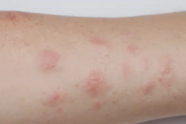 男生全身偶爾起濕疹不管它會自己痊愈嗎(圖2)