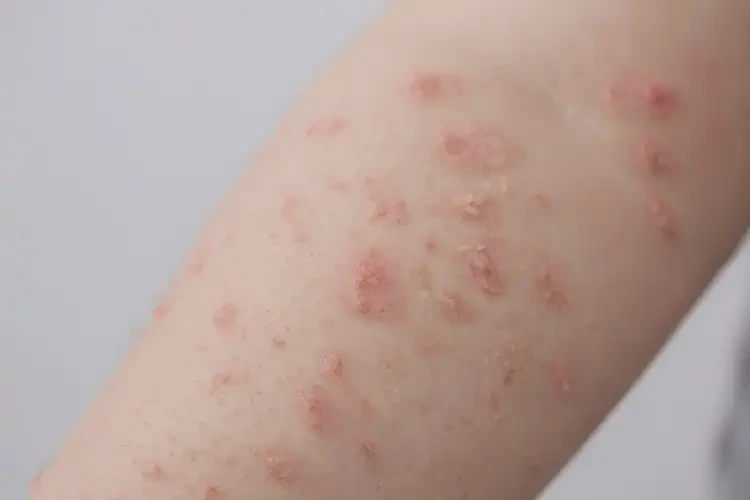 孩子手臂偶爾長濕疹不管它會自己自愈嗎(圖4)