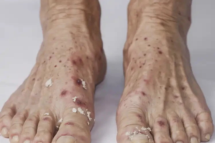 老人腳上容易長濕疹不管它會自己痊愈嗎(圖4)